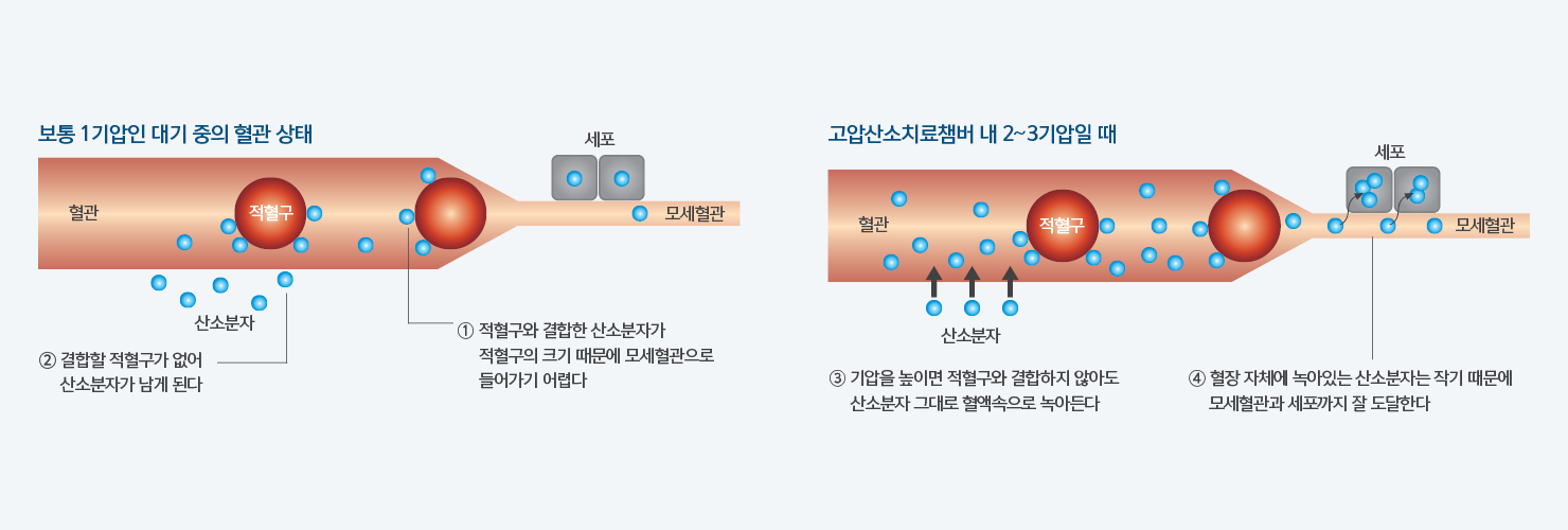 혈관 내 적혈구 결합형 산소와 혈장 용해형 산소의 차이